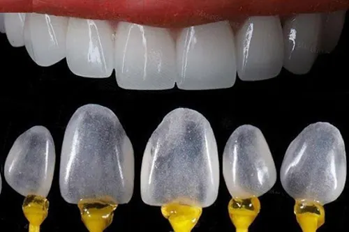 Enhancing Your Smile